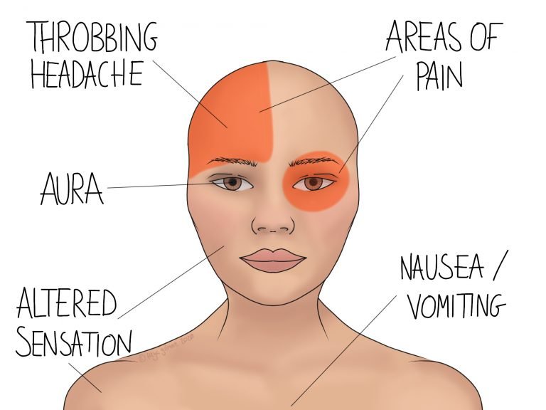 migraine-prevention-gemini-osteopathy