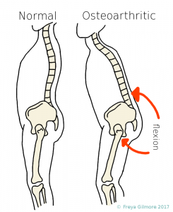 Postural changes in response to an arthritic hip