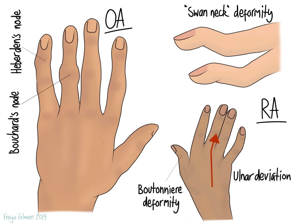 Arthritic hands