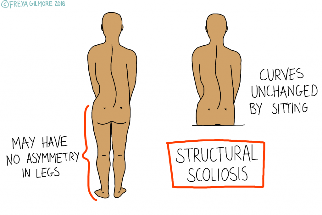 Does a having a short leg cause scoliosis? - Scoliosis Clinic UK
