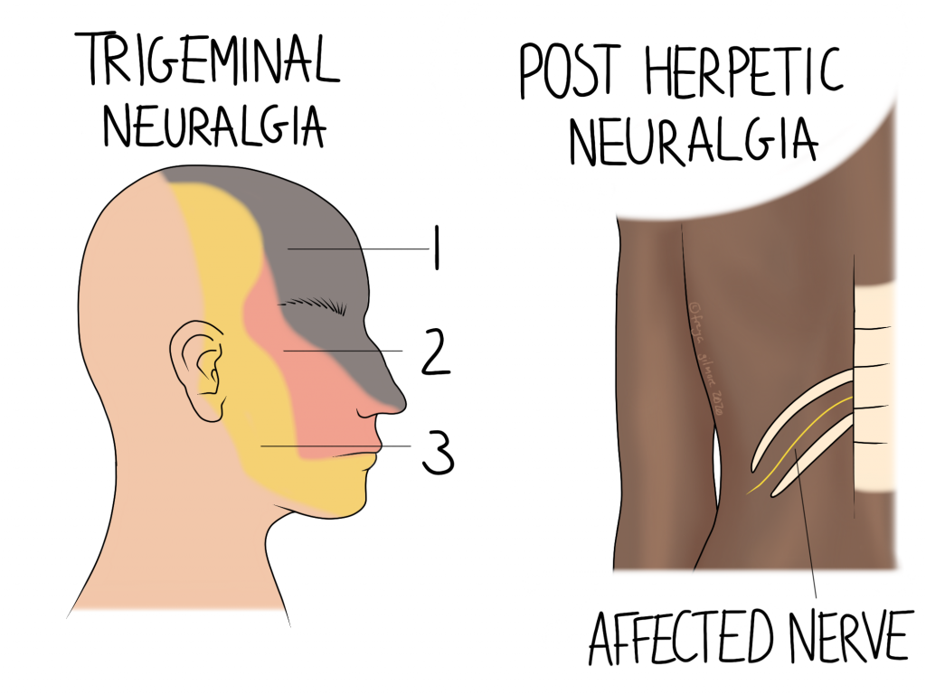 Sciatic Neuralgia Meaning In English