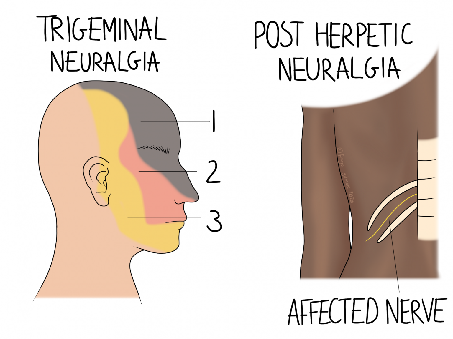 postherpetic neuralgia