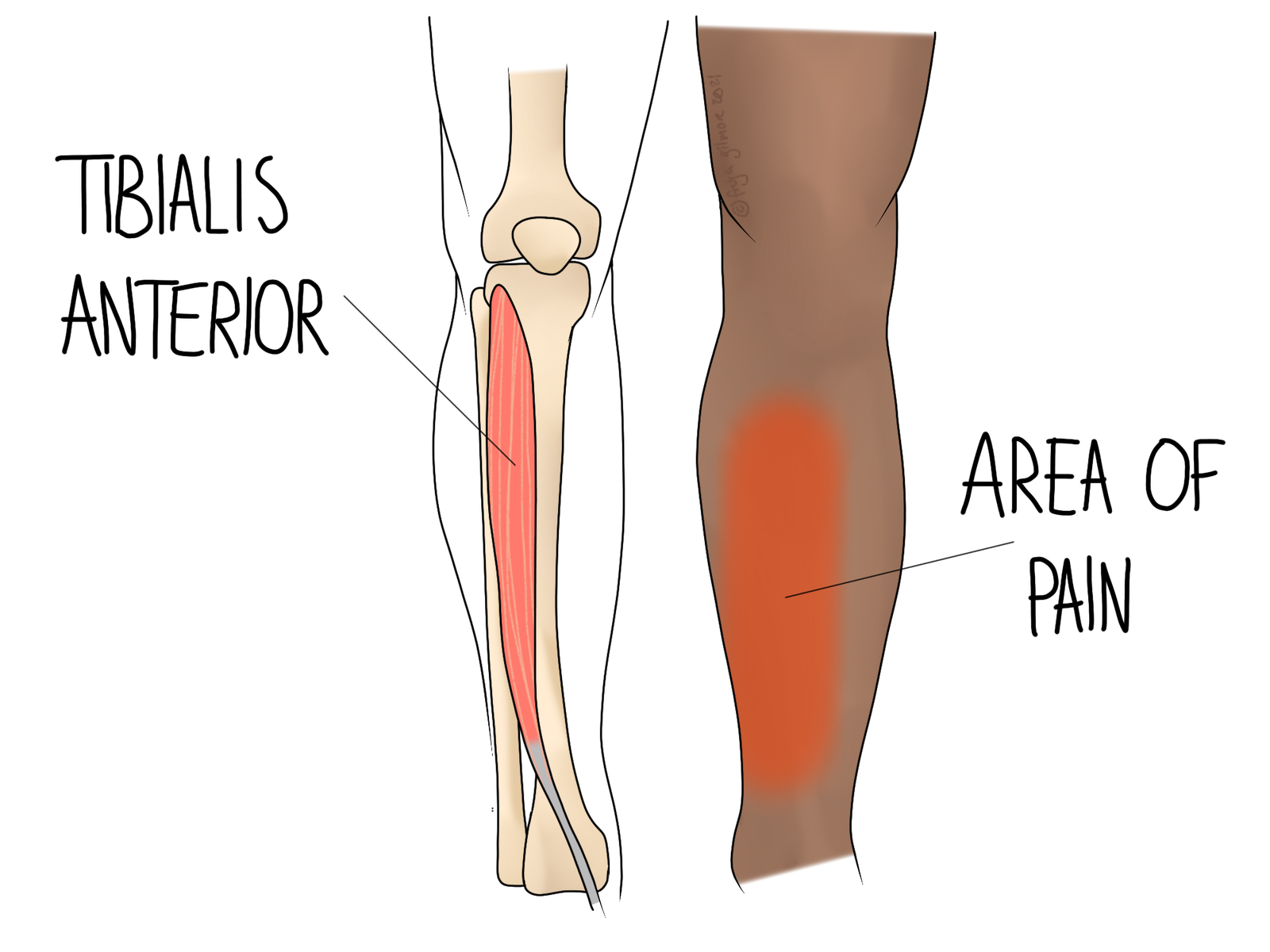  Shin Splints Gemini Osteopathy