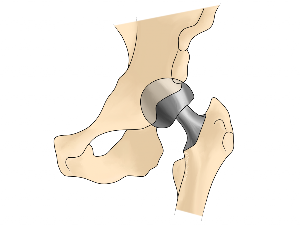 Joint replacement surgery
