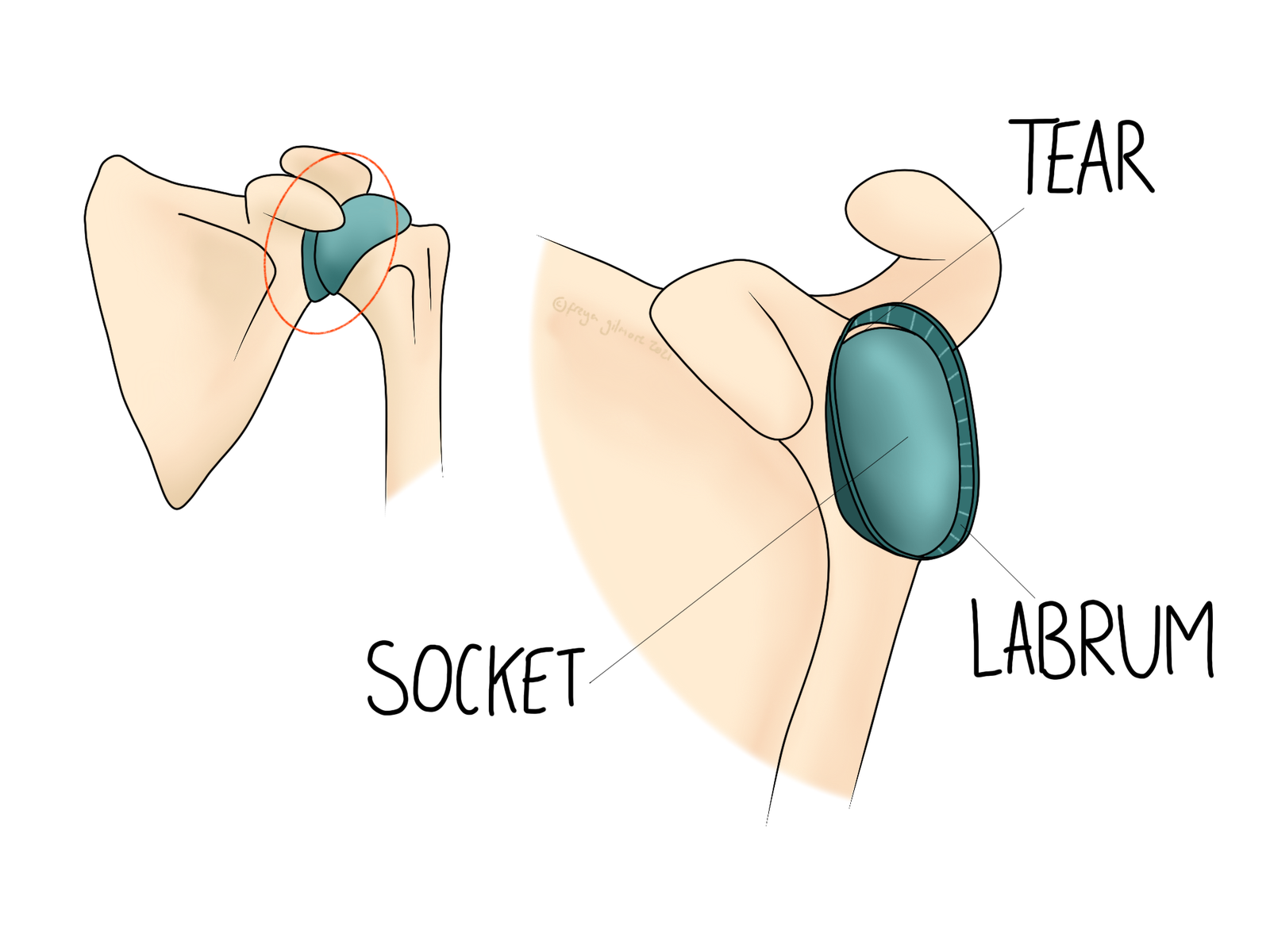 Shoulder Labrum Injury