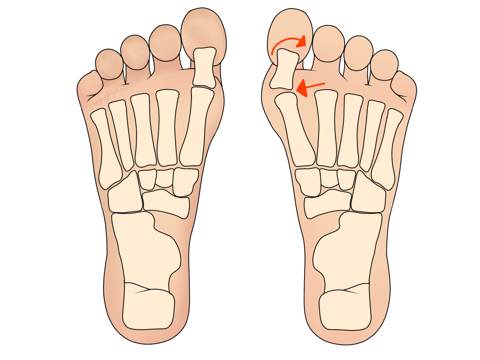 Bunions