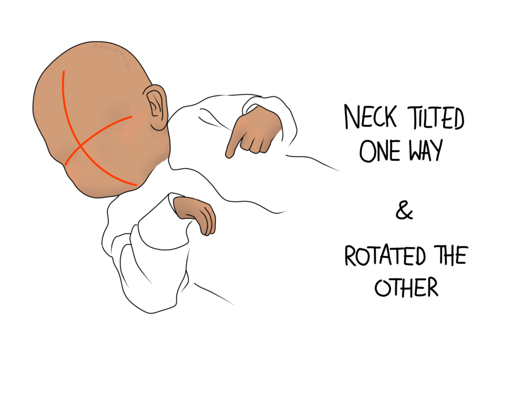 Infant Torticollis