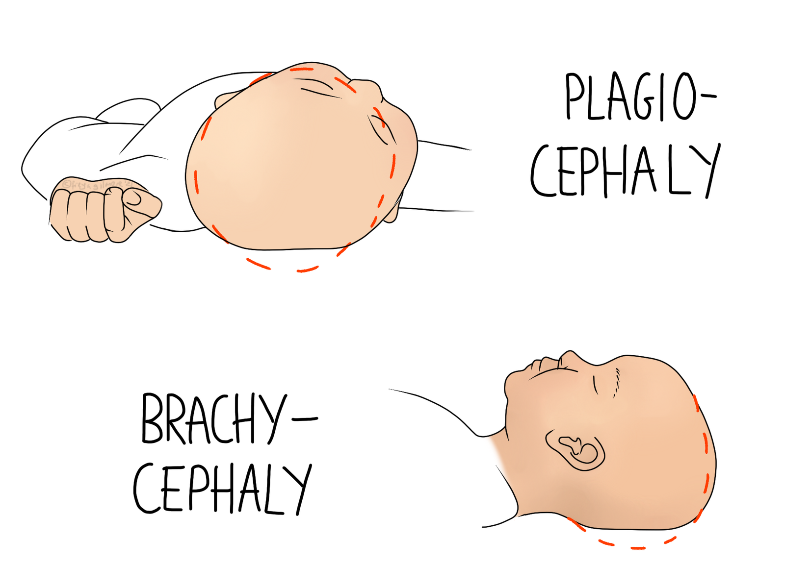 SPD: Symphysis Pubis Dysfunction - Gemini Osteopathy