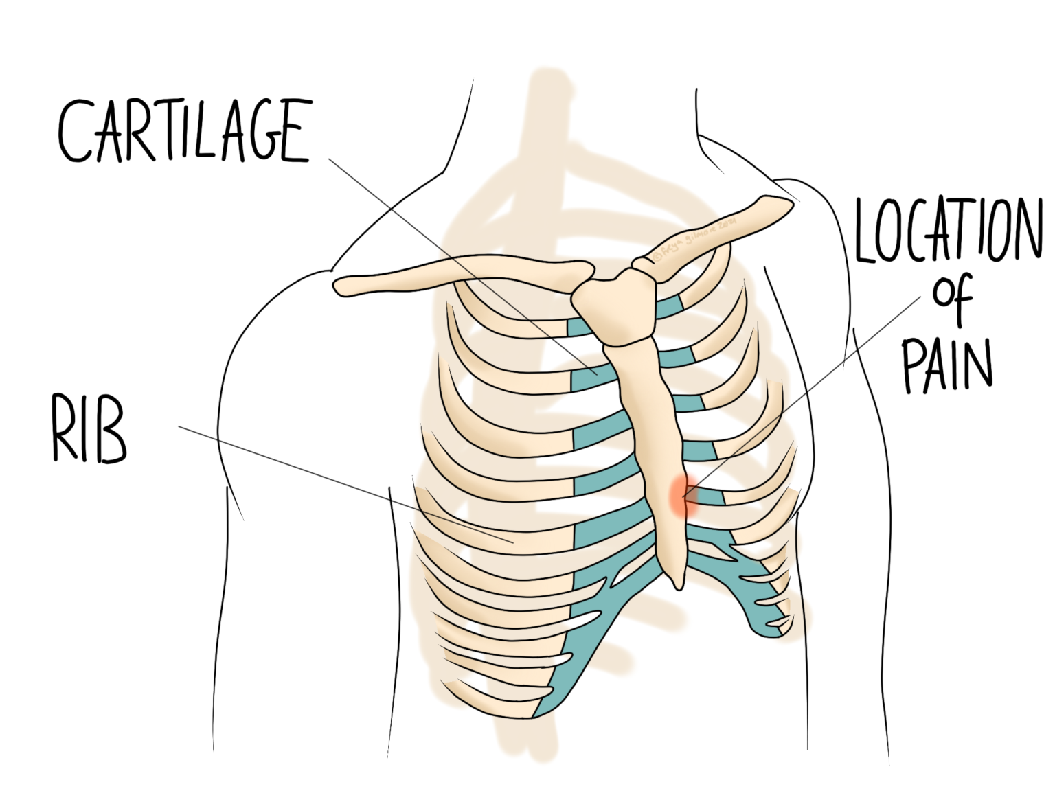 costochondritis-rib-pain-gemini-osteopathy