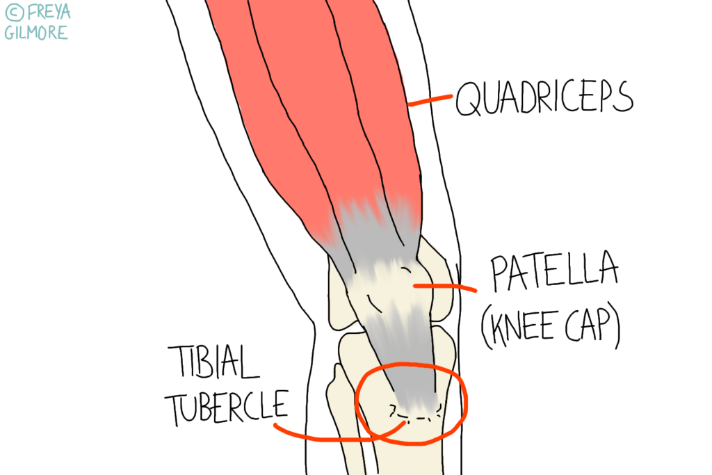 Osgood Schlatter's Disease