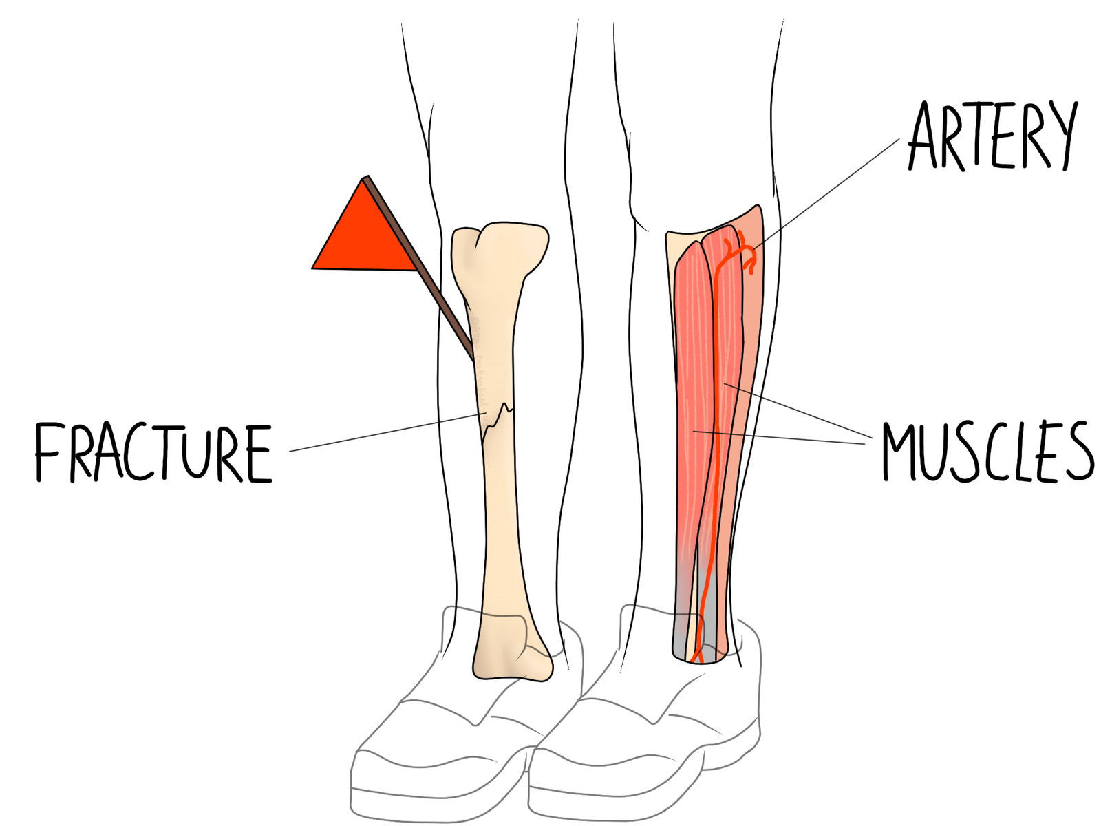 Compartment Syndrome - Gemini Osteopathy