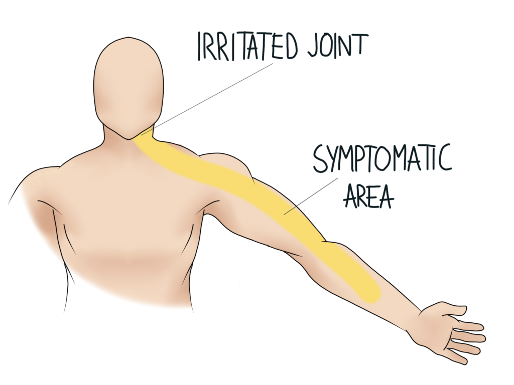 Referred pain