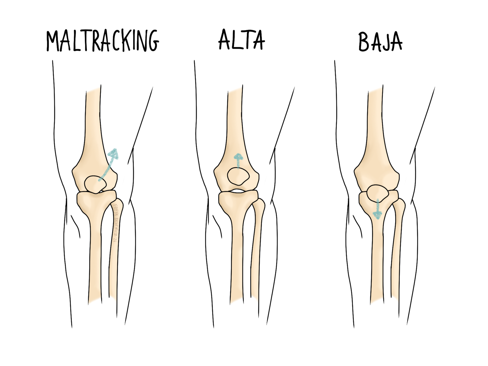 Knee cap positional variation