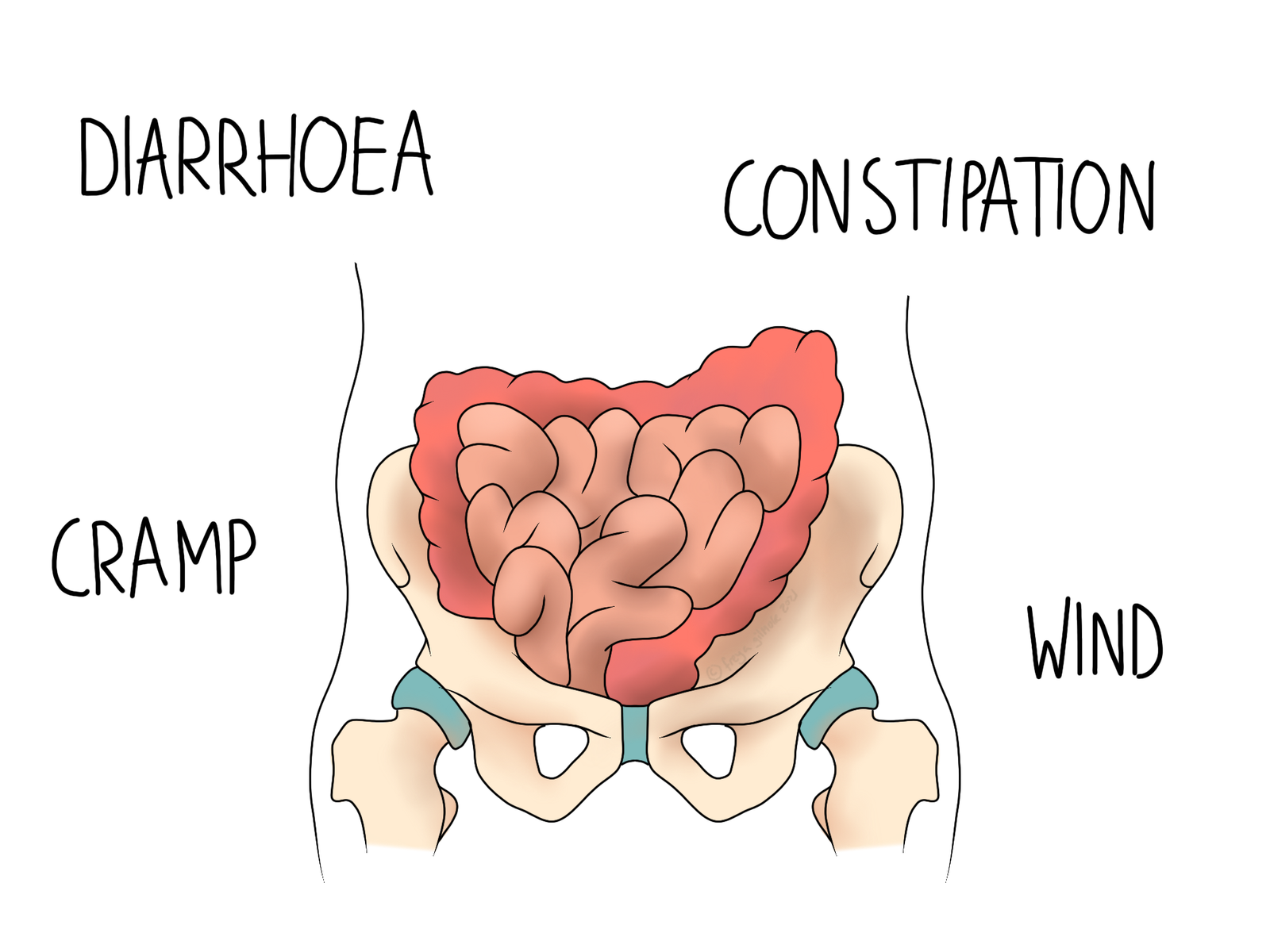 IBS: irritable bowel syndrome