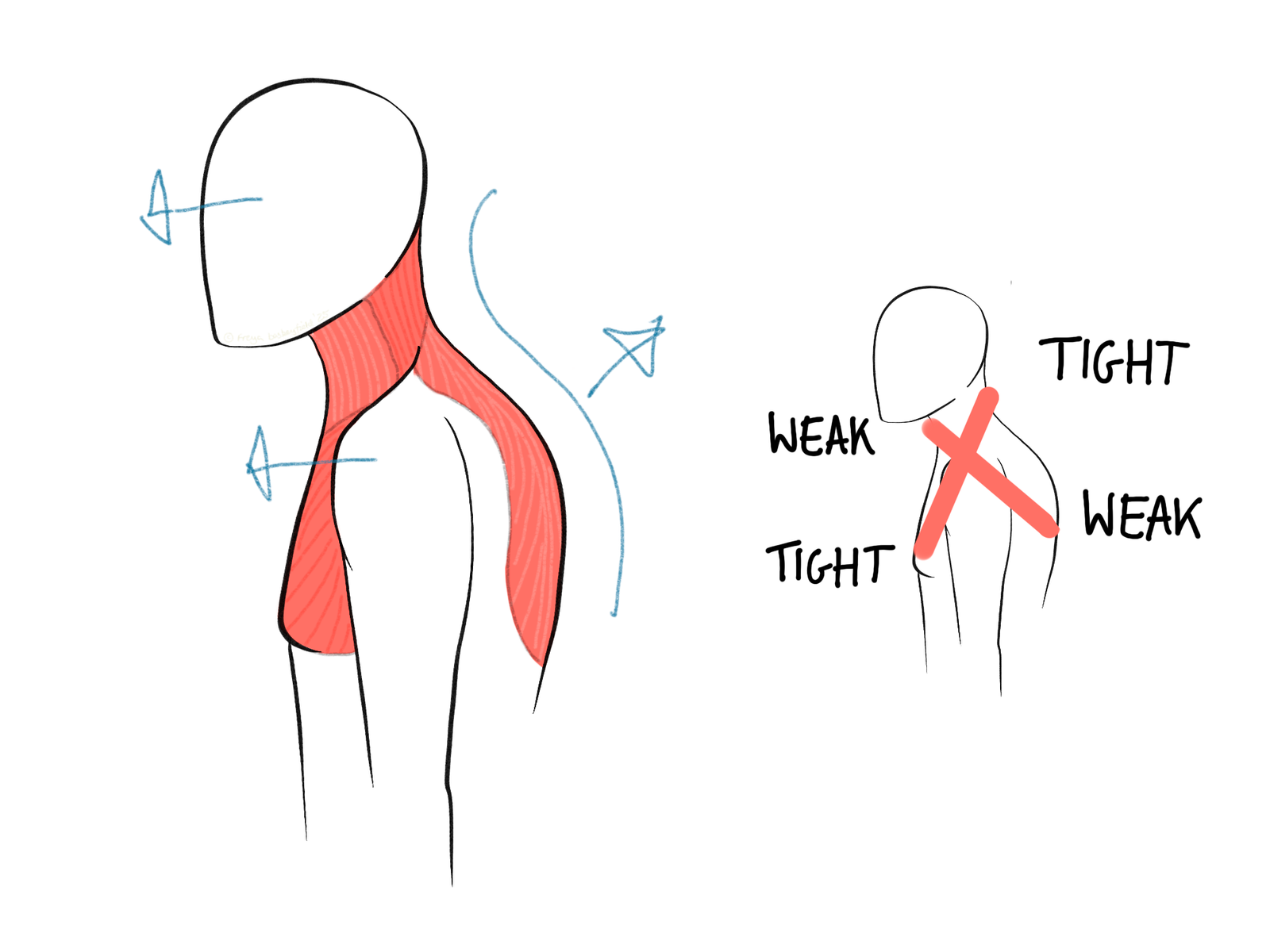Upper cross syndrome