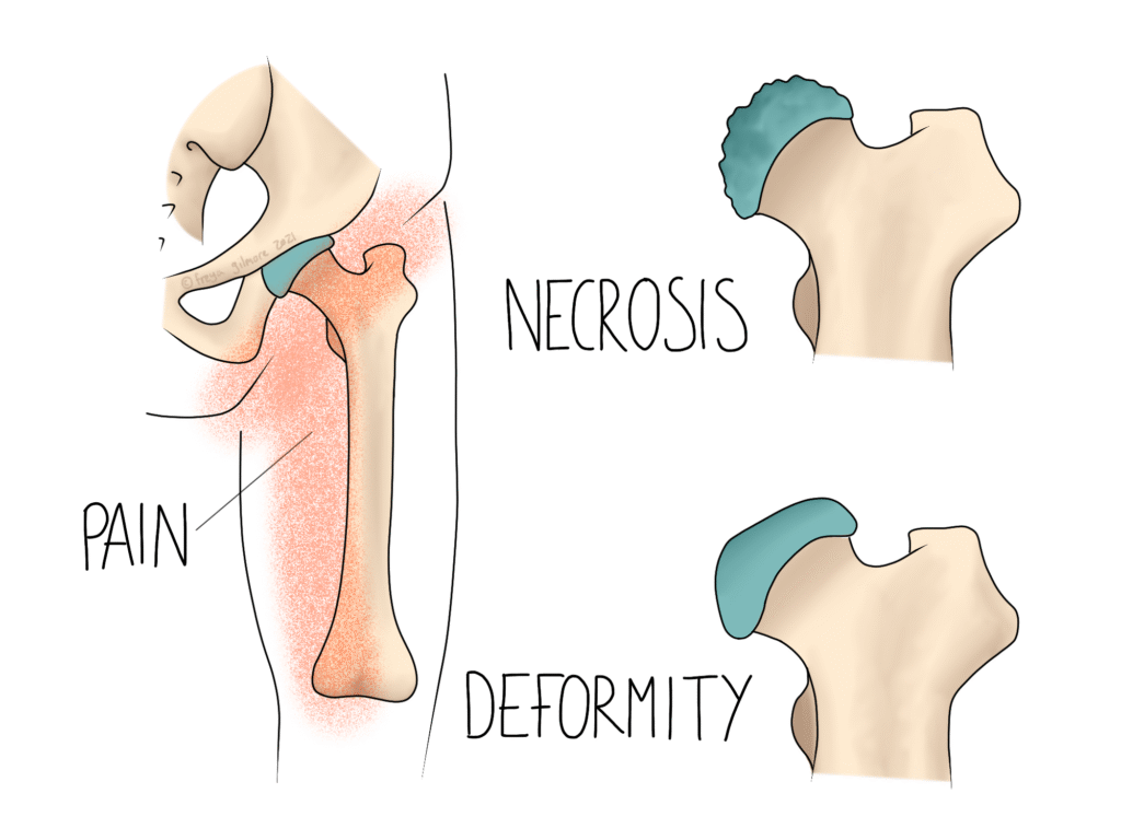 Perthes Disease